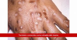 Viruela símica ya está en Colombia